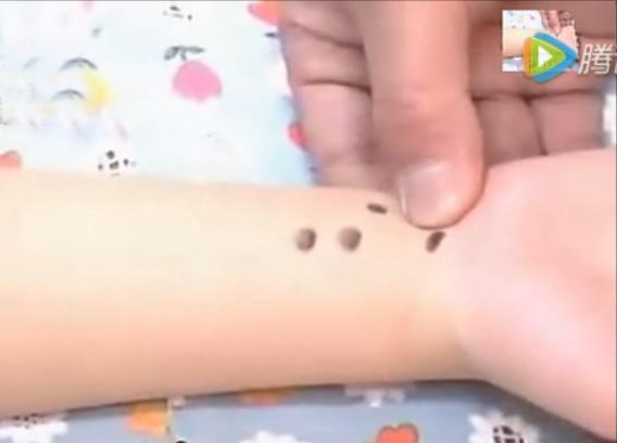 湘西点穴治疗脑瘫的名医,小儿脑瘫推拿疗法