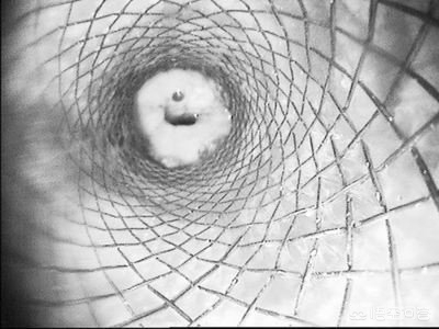 食管癌晚期食道梗阻怎么治,食道癌晚期食道堵塞怎么解决