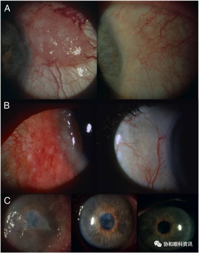 文摘速递丨5-FU单药治疗眼表鳞状细胞肿瘤的长期疗效观察