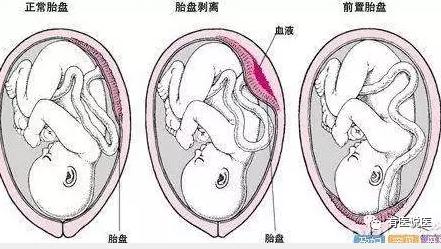 福建女子反复剖宫产子宫大出血被整个切除