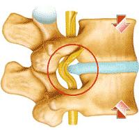 腰椎间盘突出的治疗高手，已达杭城，腰疼的你有福了