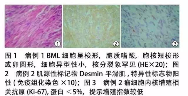 子宫平滑肌瘤疑难病例讨论,子宫平滑肌瘤案例讨论ppt