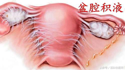 肚子里面有积水是需要开刀吗,盆腔与肚子里积液什么原因