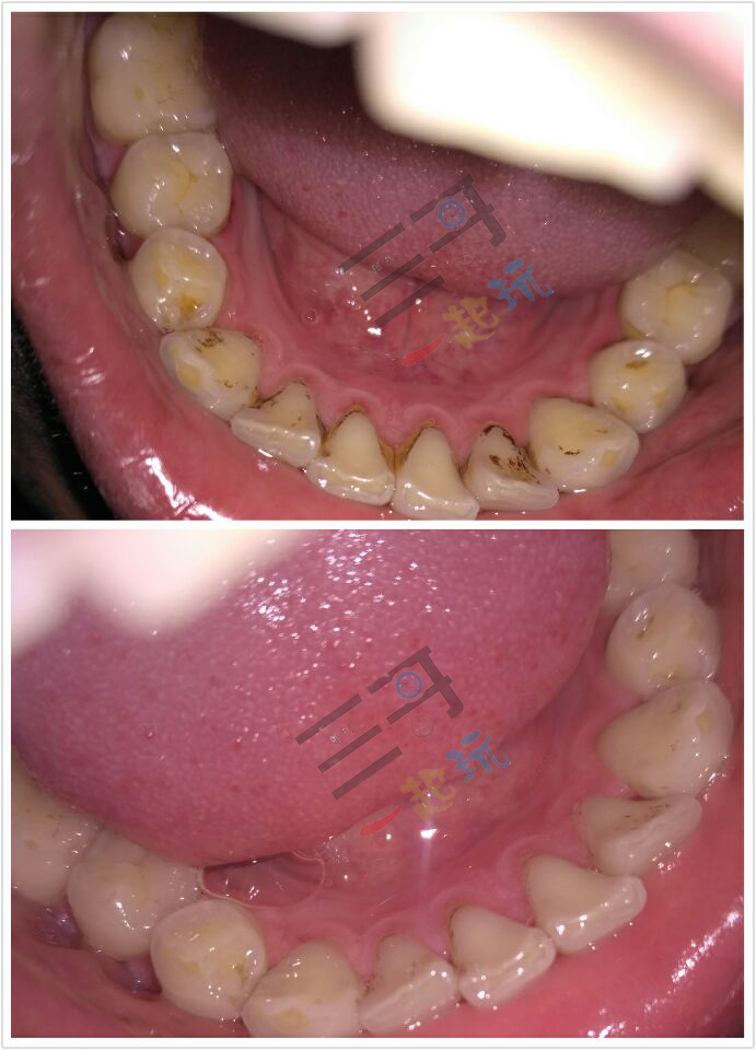 亲身体验清洁效果,洗牙体验全视频