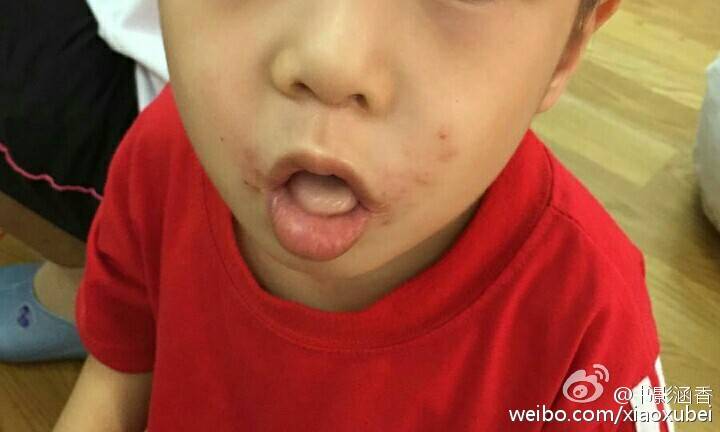 黄豆湿疹,祛湿疹偏方黄豆