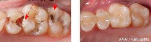 小朋友牙缝怎么清洁,大家怎么清理口腔