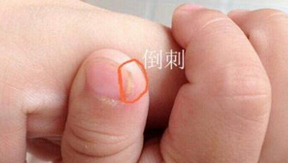 女子拔倒刺感染致整个指甲被拔掉,拔了根倒刺为什么会截肢