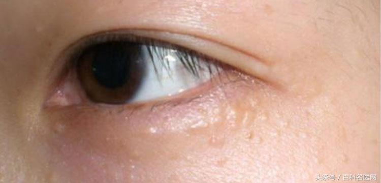 眼霜太油长颗粒,眼霜太滋润会有脂肪粒吗