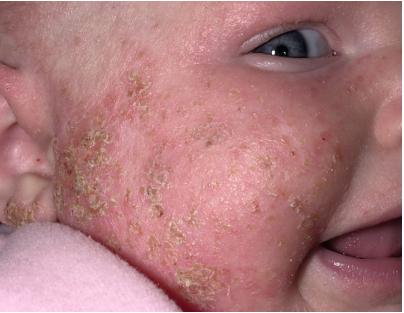 中国湿疹诊疗指南,湿疹中医专家诊疗共识