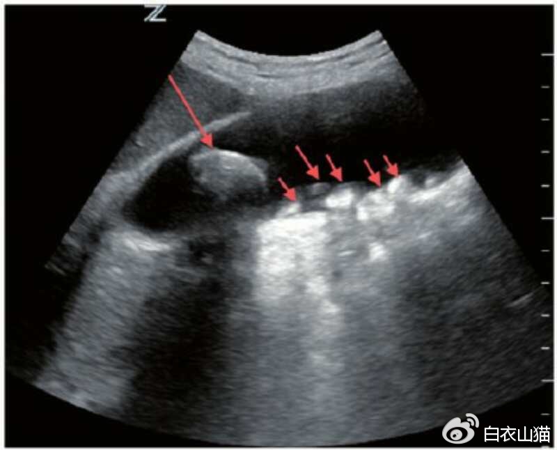 胆囊息肉癌变早期切了还要化疗吗,胆囊息肉加胆结石癌变的几率高吗