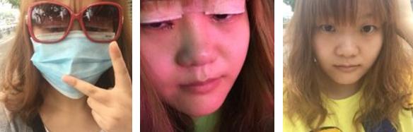 割双眼皮的危害和后遗症,拆双眼皮线痛吗