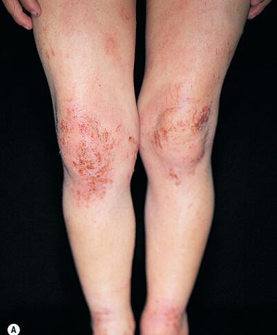 中国湿疹诊疗指南,湿疹中医专家诊疗共识