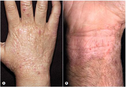 中国湿疹诊疗指南,湿疹中医专家诊疗共识