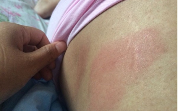 怎么缓解孕期坐骨神经臀部痛,孕期坐骨神经痛腿疼如何缓解