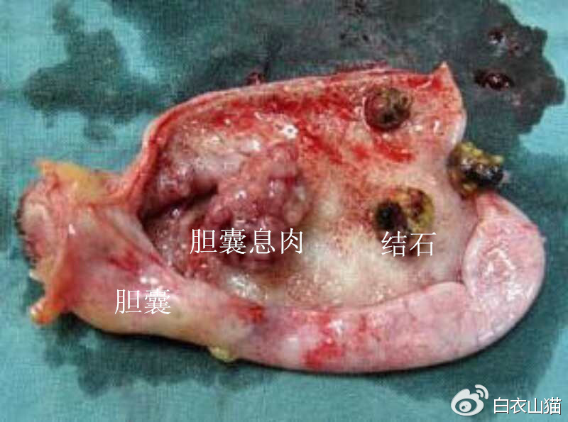 胆囊息肉癌变早期切了还要化疗吗,胆囊息肉加胆结石癌变的几率高吗