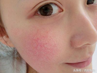 搞懂3个问题轻松解决,脸上有红的血丝擦什么
