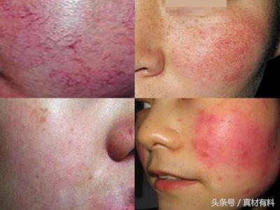 搞懂3个问题轻松解决,脸上有红的血丝擦什么