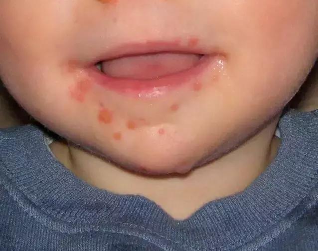 得了手足口病如何正确治疗,手足口病当感冒治会是什么后果