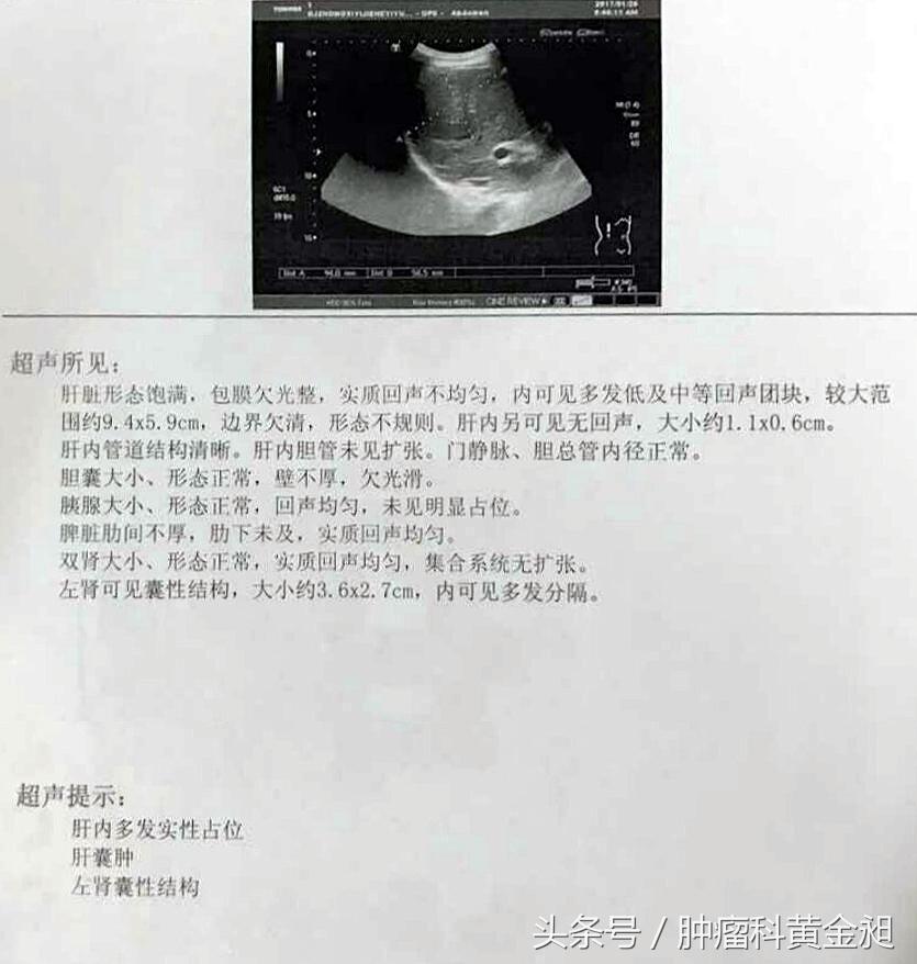 肝癌介入栓塞化疗的副作用,肿瘤介入手术栓塞血管