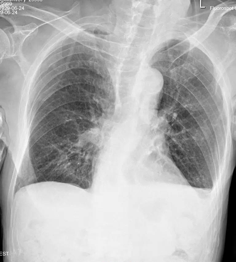 胸片怎么看胸膜粘连还是胸腔积液,胸片上怎么看局部胸膜增厚