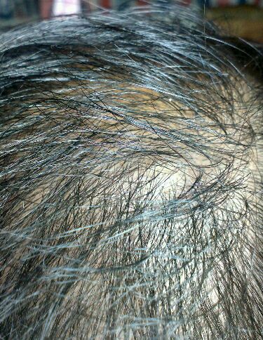 为什么现在的人脱发掉发严重,为什么年轻人老是掉头发