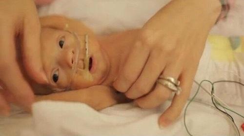 胎儿肠管扩张最坏结果,胎儿结肠肠管扩张不做羊穿