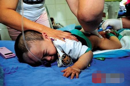 胎儿肠管扩张最坏结果,胎儿结肠肠管扩张不做羊穿