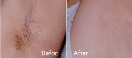 我们有没有为脱毛烦恼过,为了减肥都做过什么事