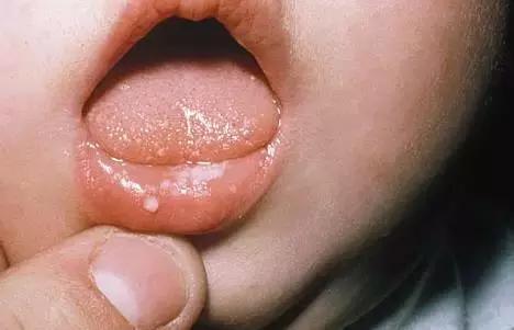 湿疹感染了严重怎么办,湿疹感染的最佳治疗方法婴儿