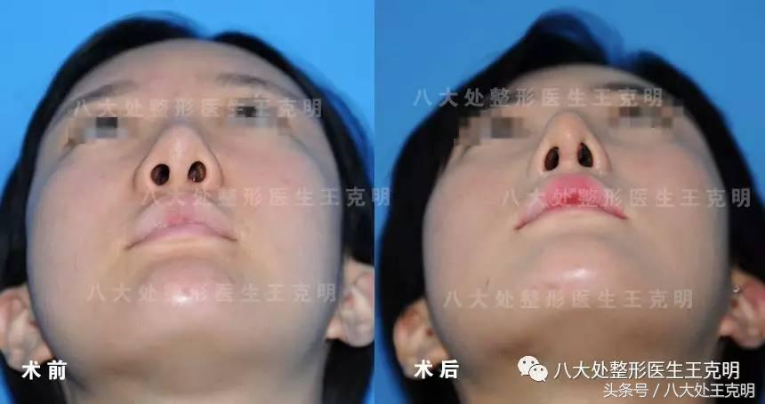 假体隆鼻透光怎么消除,假体隆鼻硅胶有可能立着吗