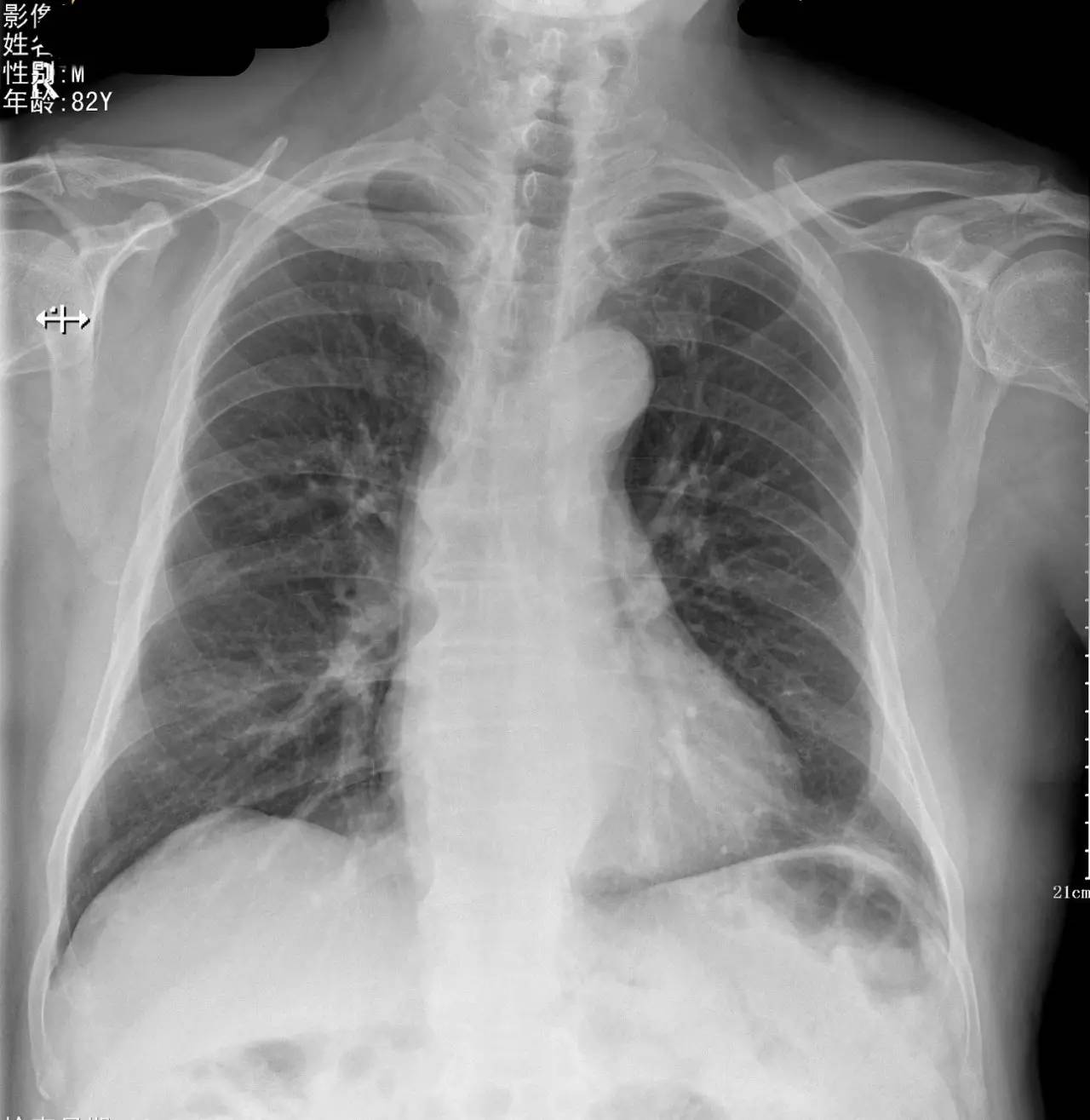 胸片怎么看胸膜粘连还是胸腔积液,胸片上怎么看局部胸膜增厚