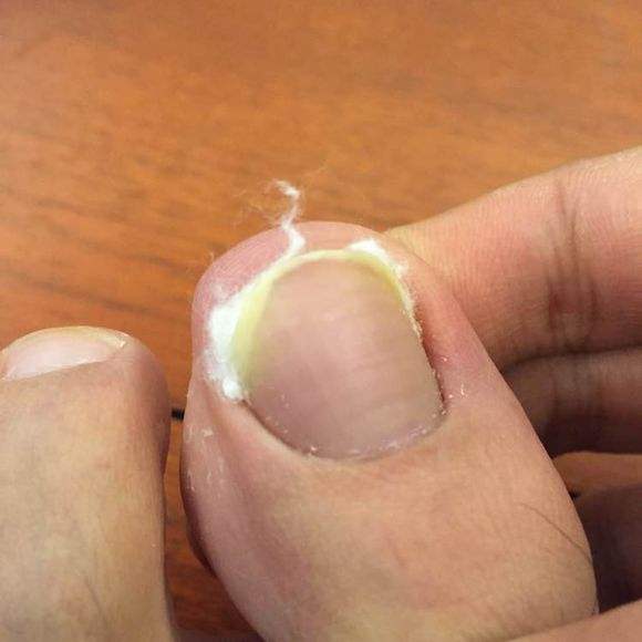 嵌甲性甲沟炎自己最佳治疗方法,嵌甲甲沟炎根治教程