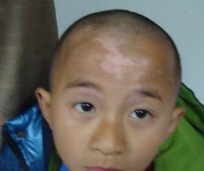 小孩子长了白斑怎么才能治好,声带白斑要关注哪些饮食