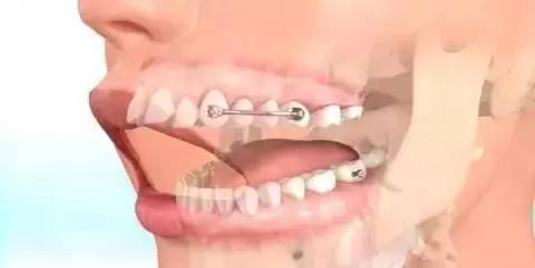 如何一秒钟矫正牙齿,牙齿矫正让你悄然改变从现在开始