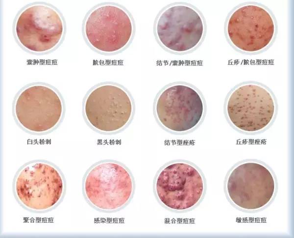 Madam问答室丨祛痘印能否刷酸，卸内眼线方法，橘色唇膏，洗眼液推荐，下身胖牛仔裤