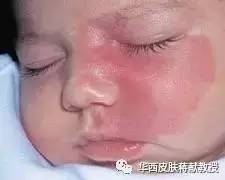 还在担心宝宝脸上的红印子会影响颜值？快来看华西专家咋个说！（内有福利）