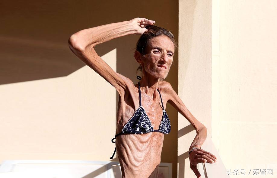 得了肾病怎么越来越瘦,得了肾病为什么感觉体质变差了