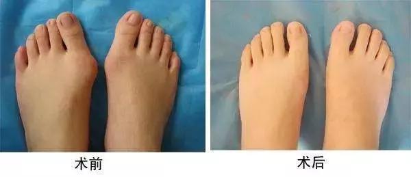 高跟鞋还是少穿吧，许多明星的高颜值，都毁在了一双脚上！