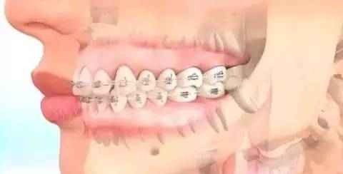 如何一秒钟矫正牙齿,牙齿矫正让你悄然改变从现在开始