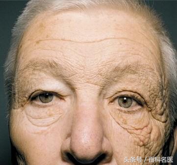 脸多油毛孔粗大黑头粉刺,修复面部毛孔黑头的方法