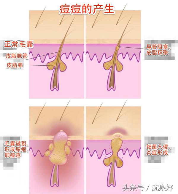 毛孔粗大还有救吗到底要如何解决,毛孔粗大有什么小方法可以解决