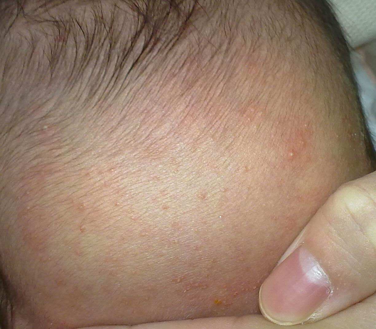 婴儿为什么会长湿疹,婴儿湿疹最怕三种菜