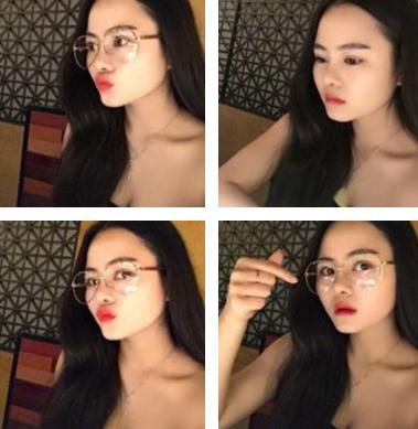 鼻综合7天山根很肿,做完膨体鼻综合修复脸特别肿