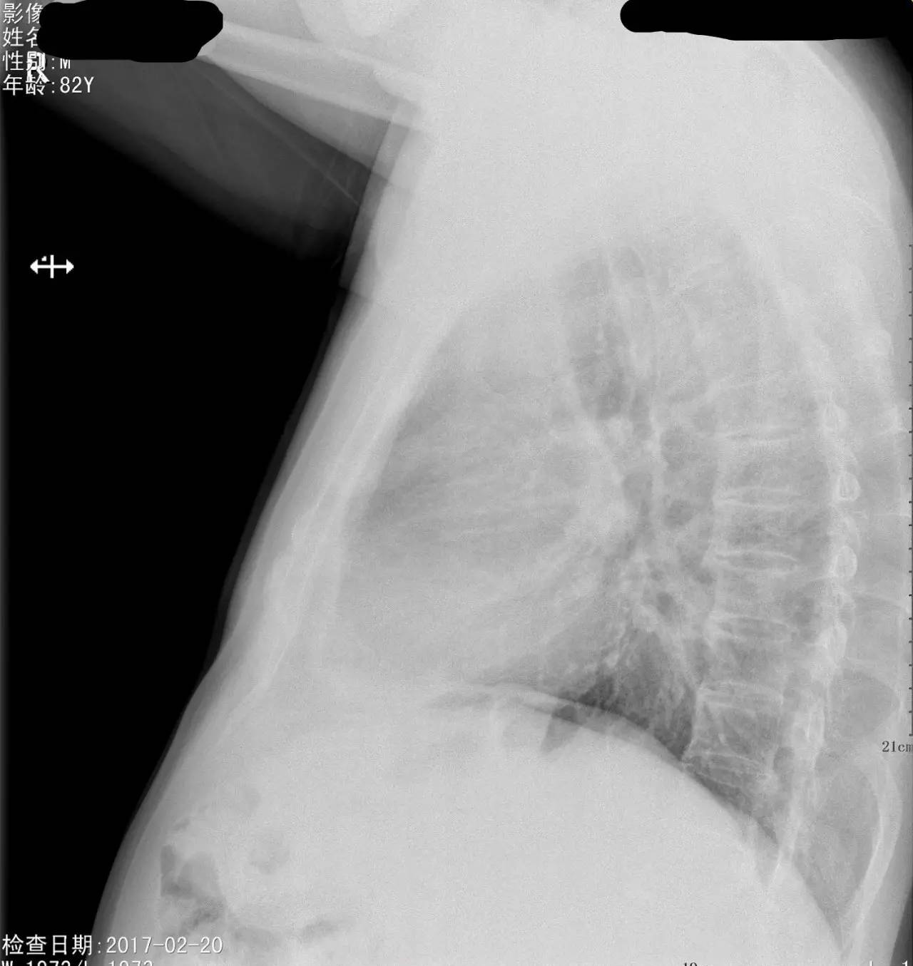 胸片怎么看胸膜粘连还是胸腔积液,胸片上怎么看局部胸膜增厚