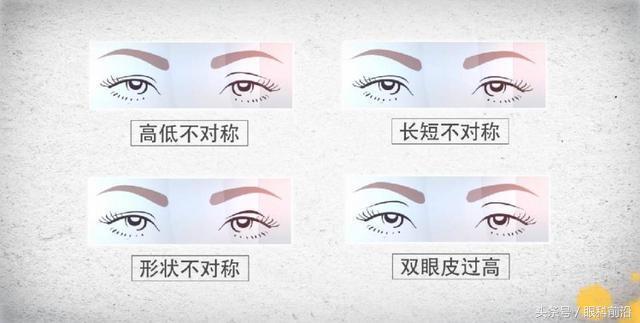 男生贴双眼皮贴会变双吗,双眼皮贴能贴多双