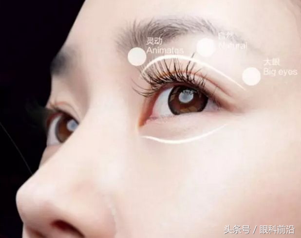 男生贴双眼皮贴会变双吗,双眼皮贴能贴多双