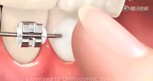 矫正钢丝末端扎嘴怎么解决,矫正钢丝末端扎嘴在家怎么办