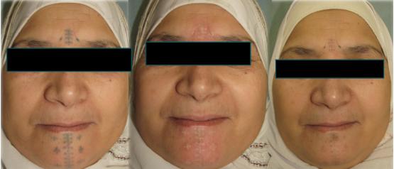 纹身可以遮盖老纹身吗,如何用纹身遮盖旧纹身