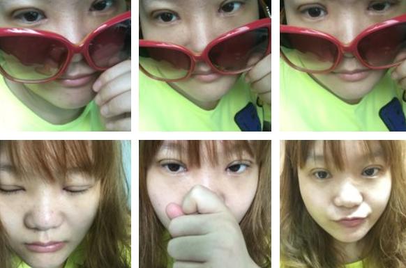 割双眼皮的危害和后遗症,拆双眼皮线痛吗