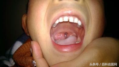 扁桃体发炎反复发烧39度多怎么办,10岁儿童扁桃体反复发炎吃什么药